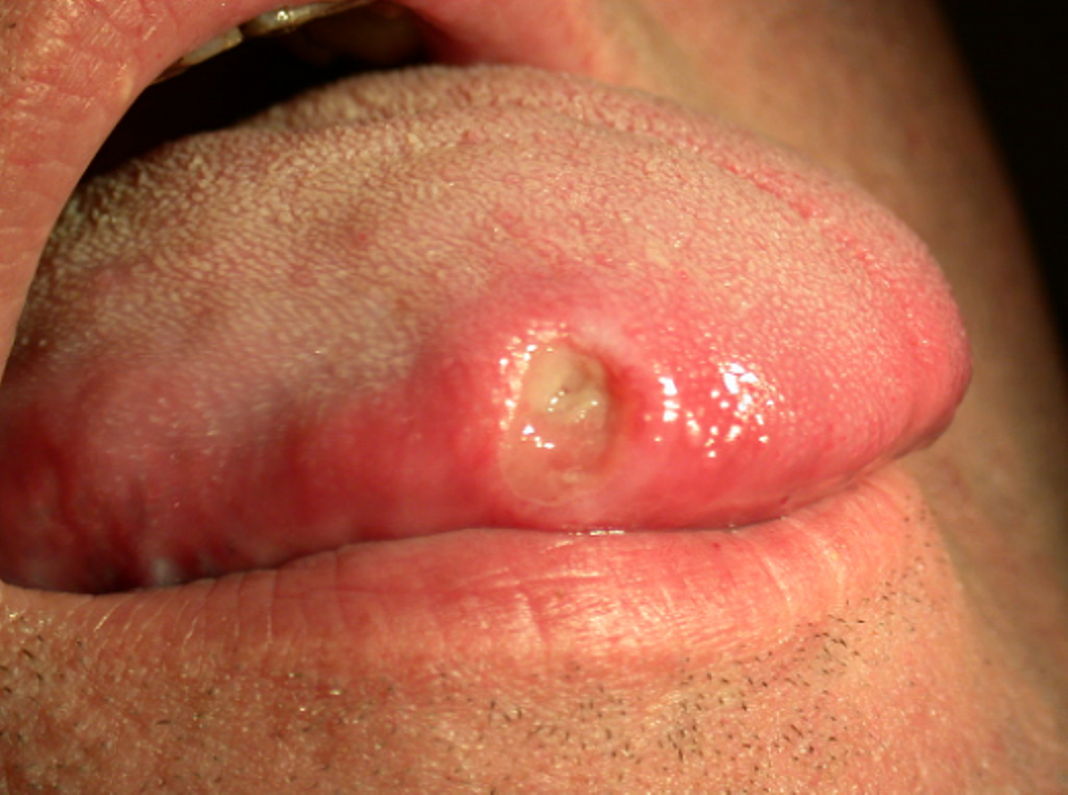 отек языка при сифилисе