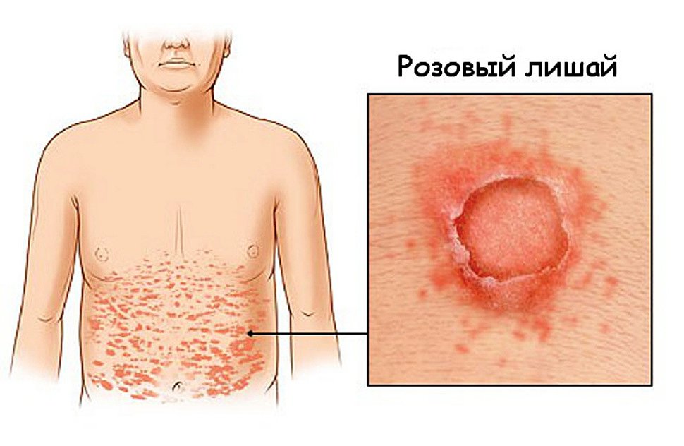 Розовый лишай (лишай Жибера): симптомы, лечение, причины возникновения