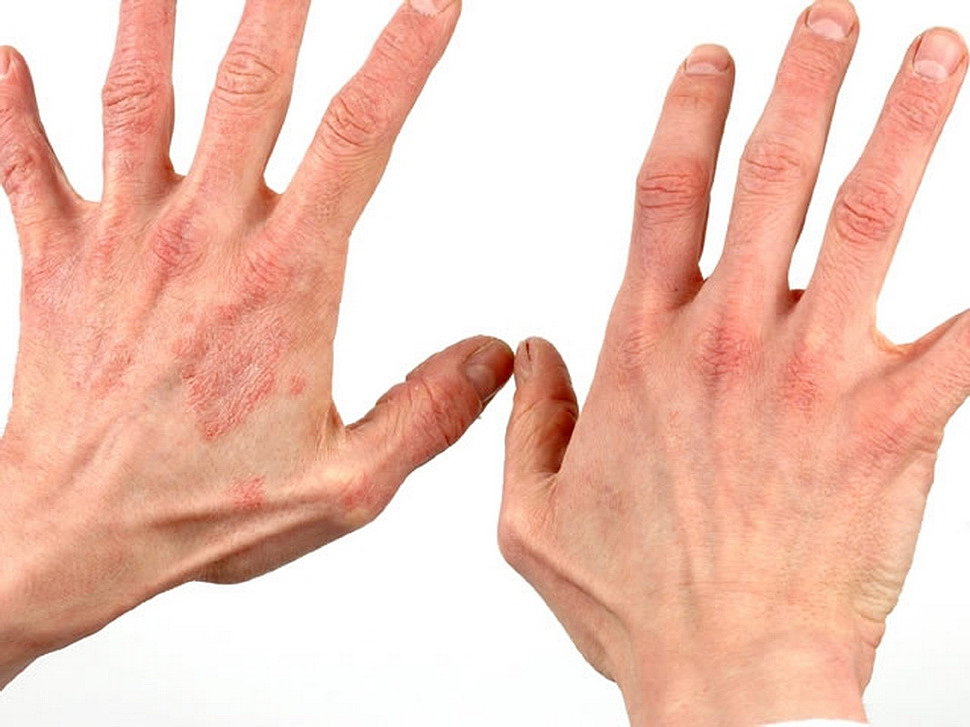 аллергический дерматит неотложная помощь thumbnail