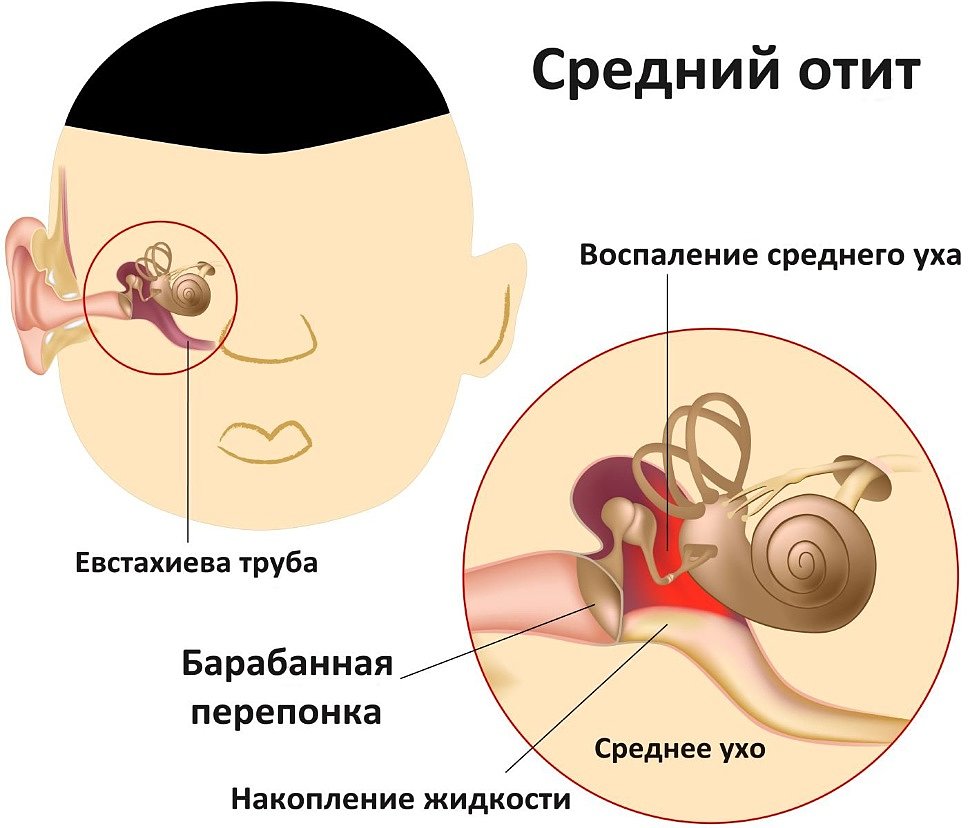 От аденоидов болят уши
